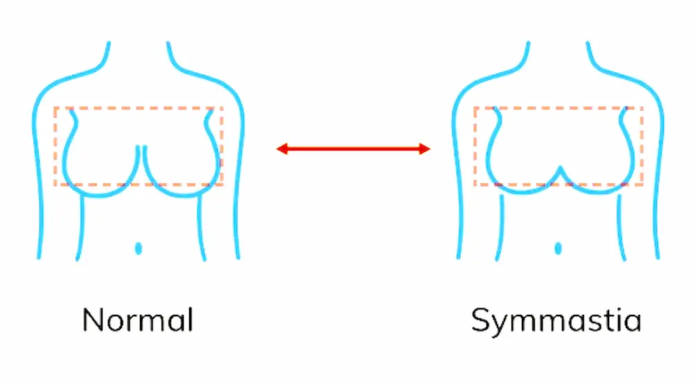 congenital symmastia correction