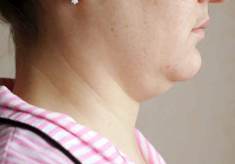 5 Things that you need to know about before getting chin liposuction